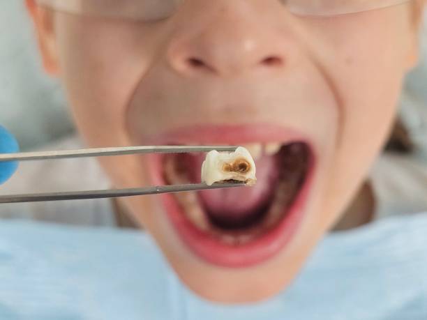 Best Emergency Dental Care for Broken or Chipped Teeth in Cuthbert, GA